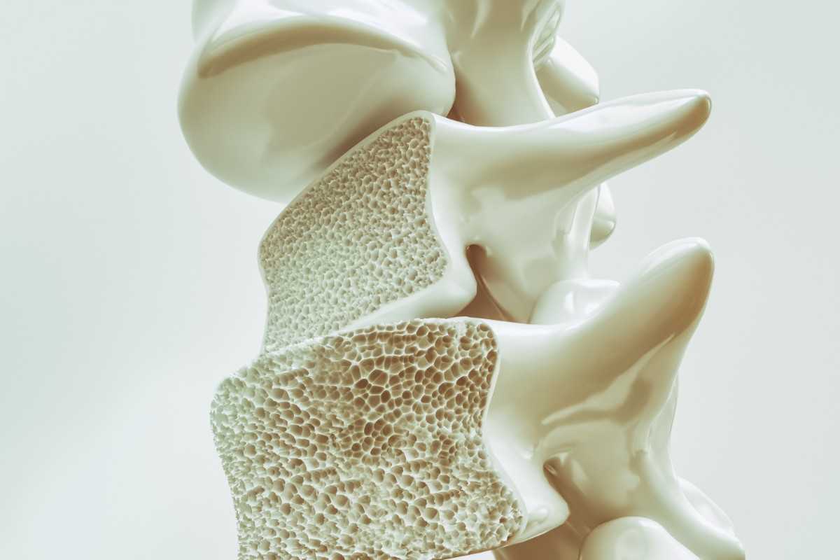 Investigadores de la Universidad Internacional de Florida; encontraron un nuevo tratamiento contra los efectos de la osteoporosis. | Foto: Cortesía.